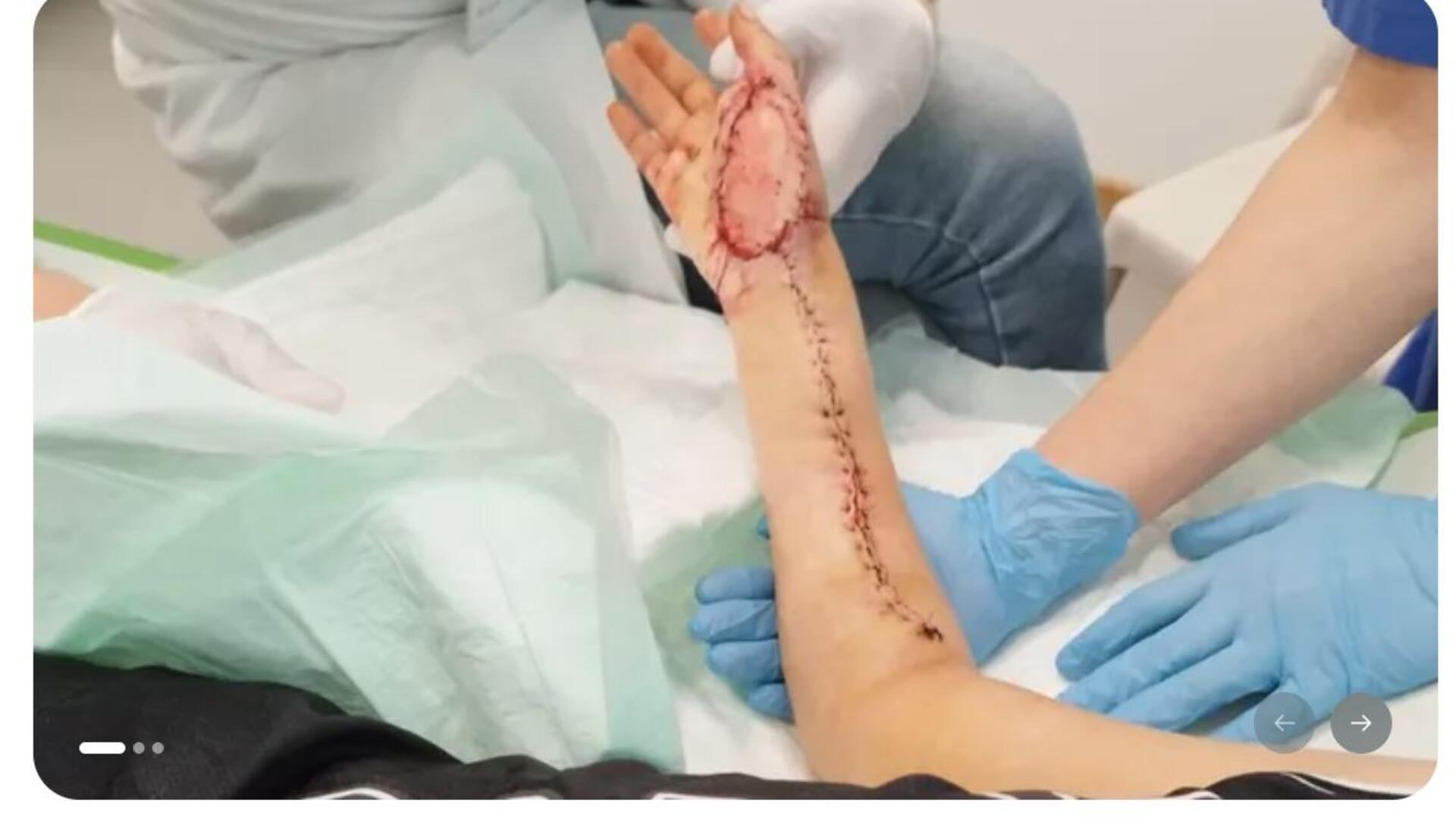 Nach der Explosion der „Wühlmaus-Sprengfalle“ wurde der achtjährige Findorfer Junge per Rettungshubschrauber zum UKE nach Hamburg geflogen. Inzwischen musste er sich elf Operationen unterziehen.